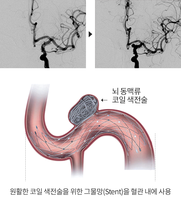 뇌동맥류 코일색전술 : 원활한 코인 색전술을 위한 그물망(Stent)을 혈관 내에 사용